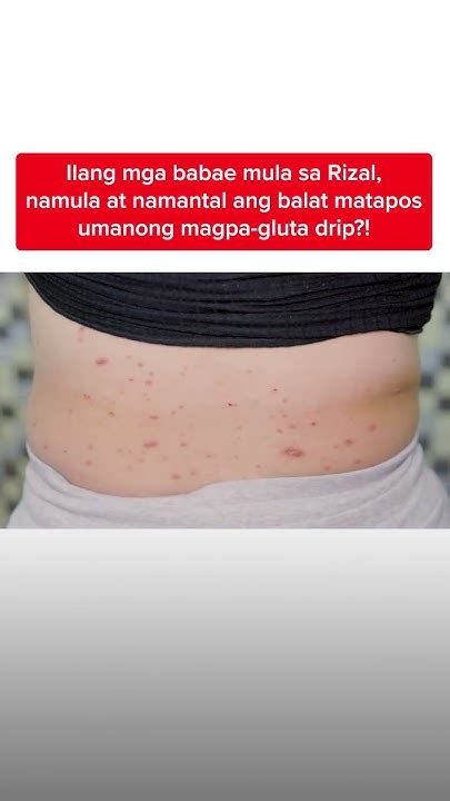 Magkakaibigang babae, namula at nagsugat ang mga balat dahil .